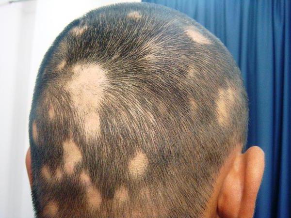 Alopezie bei Kindern: Ursachen und Behandlung. Fokale und totale Alopezie bei Kindern