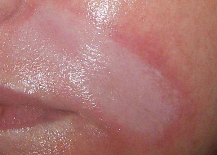 Hyaluronsäure für die Lippen: Bewertungen, Fotos vorher und nachher