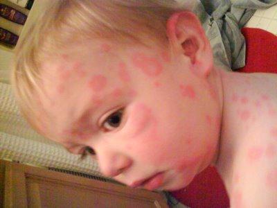 Allergie auf die Haut des Gesichts