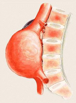 ein Aneurysma ist