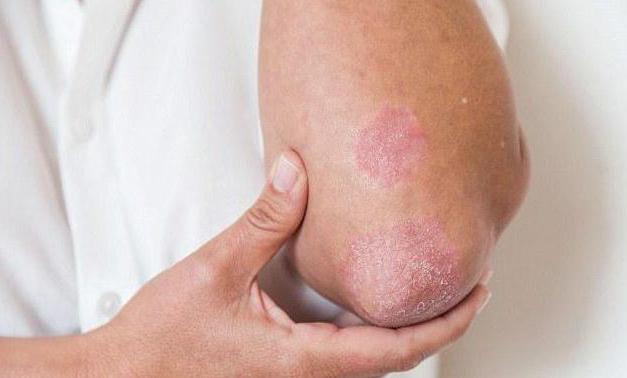 "Anti Psori Nano": Bewertungen von Ärzten. Psoriasis Anti Psori Nano