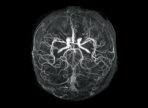 zerebrales Angioödem von Präparaten zur Behandlung von Hirngefäßen
