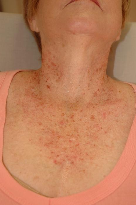 Dermatitis. Behandlung, Prävention, Symptome.