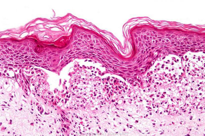 Behandlung von tödlicher Dermatitis 