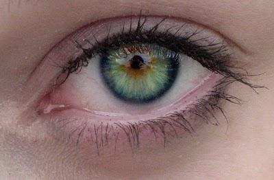 partielle Heterochromie