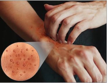 Was sind die Ursachen für Hautausschlag an den Händen?