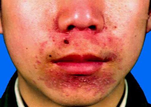 orale Dermatitis bei Kindern