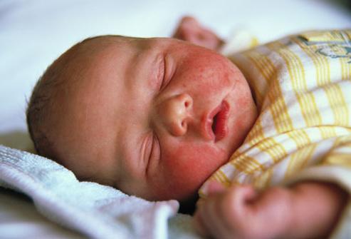 Das Schwitzen im Gesicht des Neugeborenen. Ursachen für das Aussehen