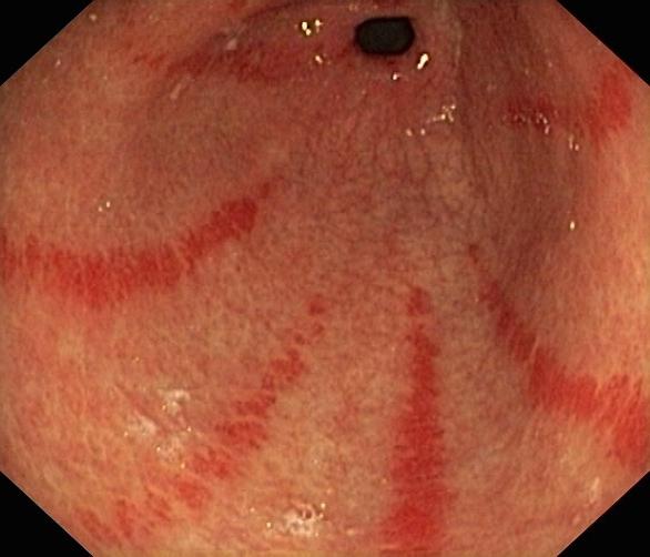 Symptome einer chronischen Gastritis