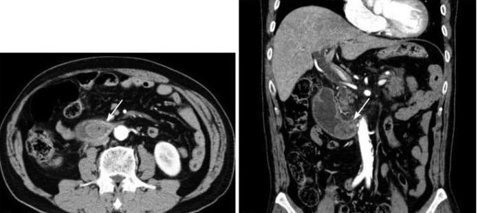 Syndrom der resultierenden Schleife: Diagnose und Behandlung