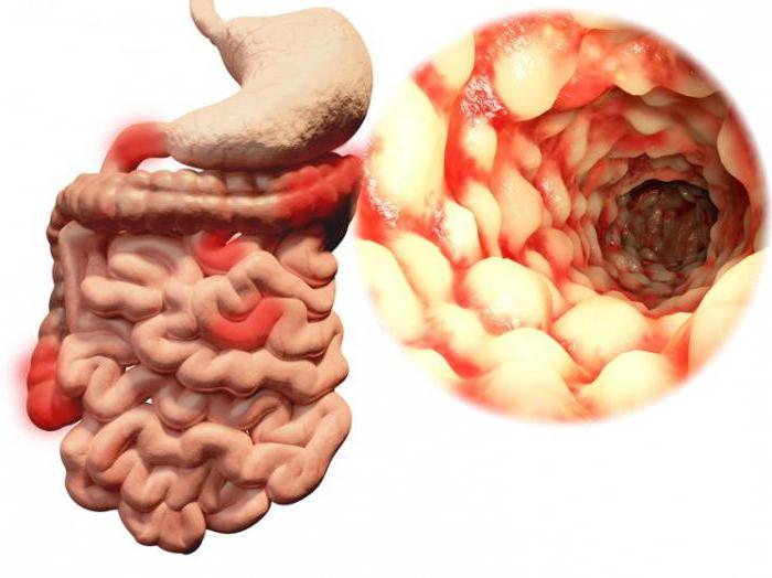 Morbus Crohn Symptome und Behandlung