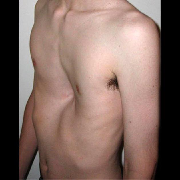 Trichterförmige Verformung der Brust: Merkmale des Auftretens und der Folgen