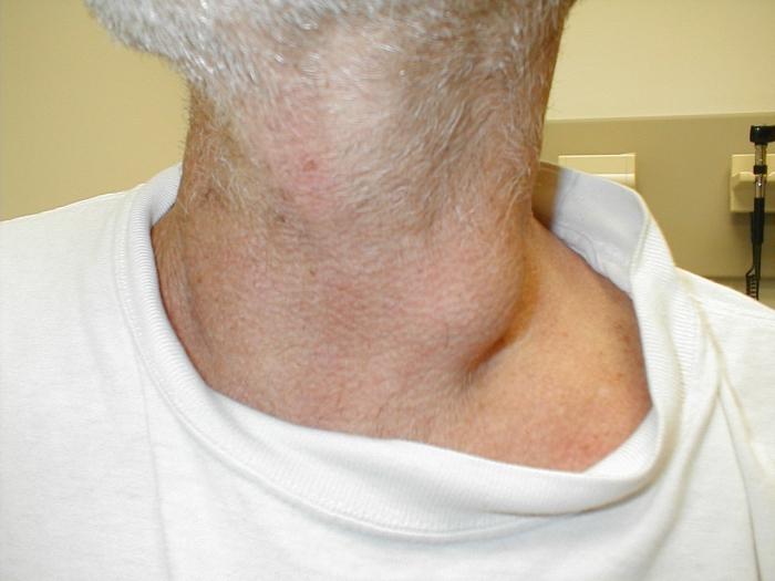 Der lymphonodus auf dem Hals hat entzündet, was man macht oder macht